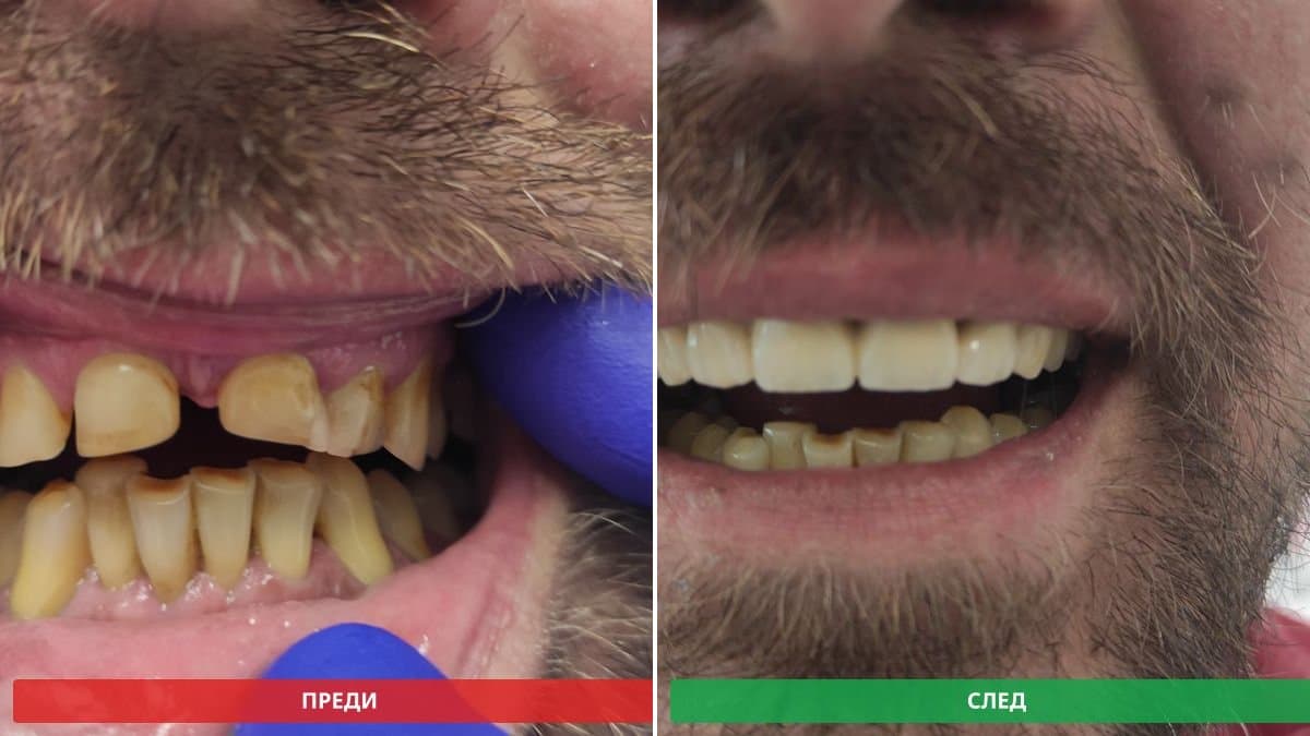 След - възстановени предни зъби, усмивка