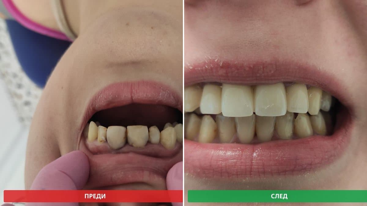 След — възстановени предни зъби (основно изображение)