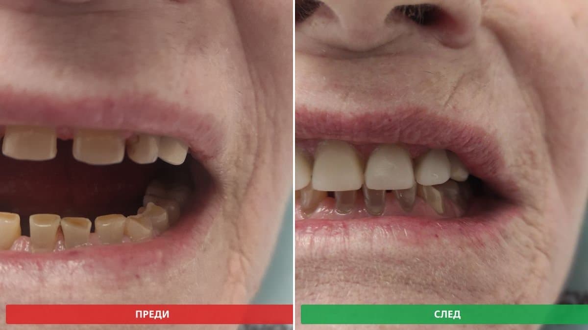 Резултат след дентален бондинг на предни зъби